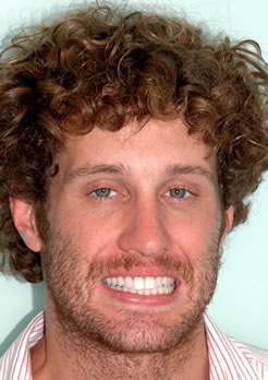 Clareamento para o dente Clareamento para o dente