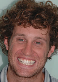 Resultado final Clareamento Dental Resultado final Clareamento Dental