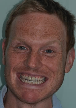 tratamento coroas em porcelana