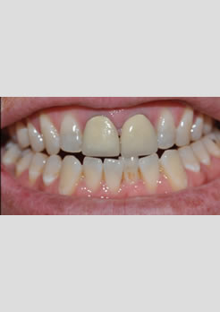 dentes antes do tratamento com coroas em porcelana