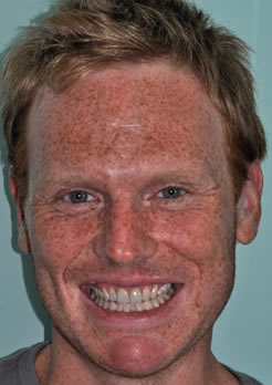 resultado final coroas em porcelana