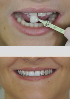 lente de contato dental rj lente de contato dental rj
