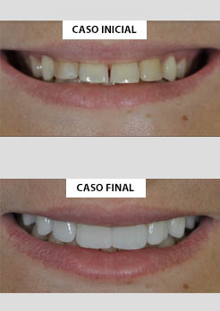 facetas ultrafinas facetas ultrafinas