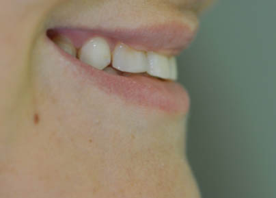 antes lente de contato dental antes lente de contato dental