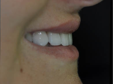 depois lente de contato dental depois lente de contato dental