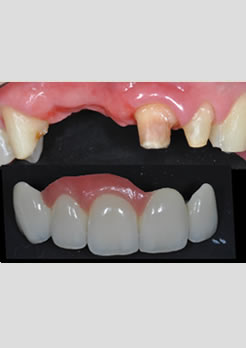 dente antes do tratamento ponte fixa de porcelana