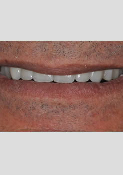 resultado ponte fixa de porcelana