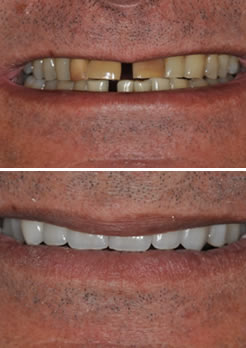 tratamento ponte fixa de porcelana