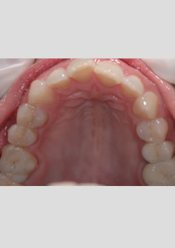 Tratamento com Blocos de porcelana