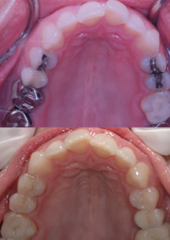 Odontologia - Blocos de porcelana