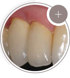 Implante de 1 dente