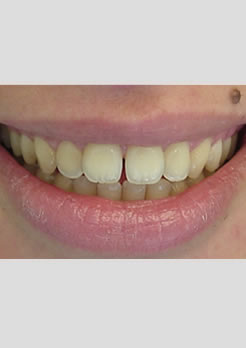 Fechamento de diastema