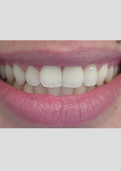 tratamento dentário diastema