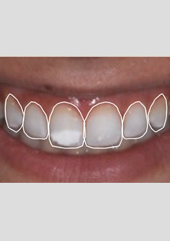 Simulação do sorriso