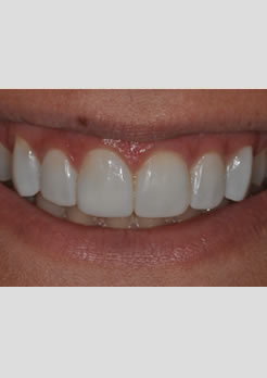 Facetas de resina - resultado