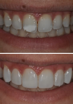 Antes e depois tratamento facetas