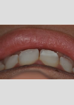 Tratamento do dente manchado