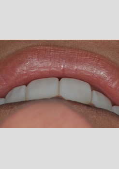 Novos dentes com facetas de resina