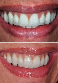 Implante dentário Niterói