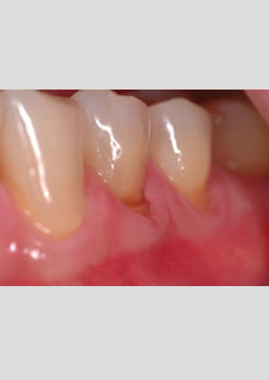 restaurações em resina