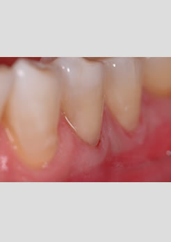 tratamento para os dentes
