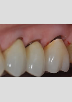 restaurações dentárias