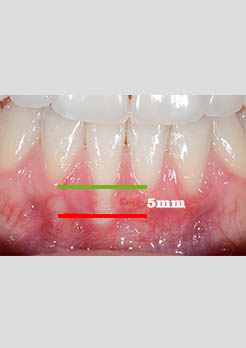Enxerto Gengival Niterói