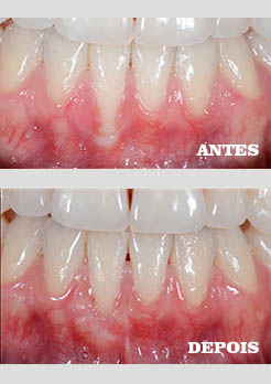 Enxerto Gengival Niterói