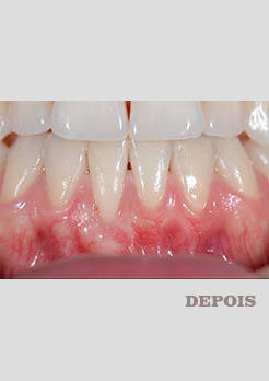 Enxerto Gengival Niterói