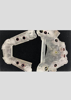Cirurgia Guiada Implantes Dentários Cirurgia Guiada Implantes Dentários