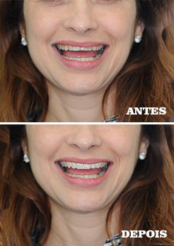 resultado ponte fixa de porcelana