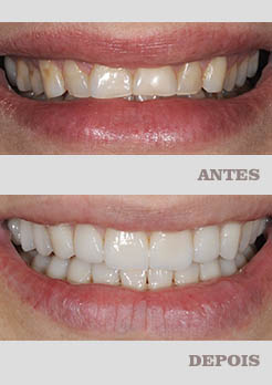 tratamento ponte fixa de porcelana