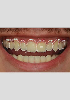 Tratamento de Clareamento Dental Niterói