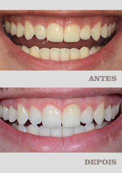 Tratamento de Clareamento Dental Niterói