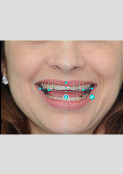 Ponte fixa de porcelana