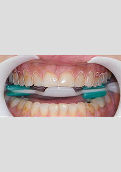 tratamento de lente de contato dental