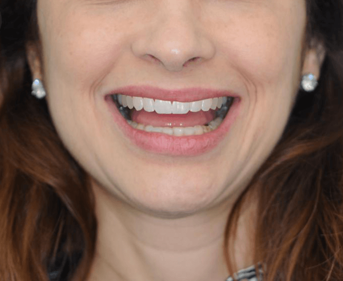 foto2 Simulação do Sorriso - Dentista em Niterói
